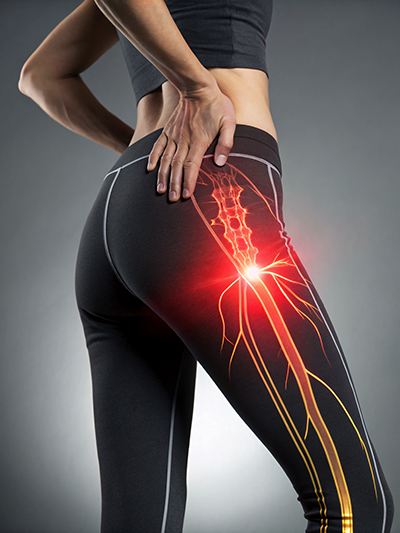 Sciatic Nerve Pain