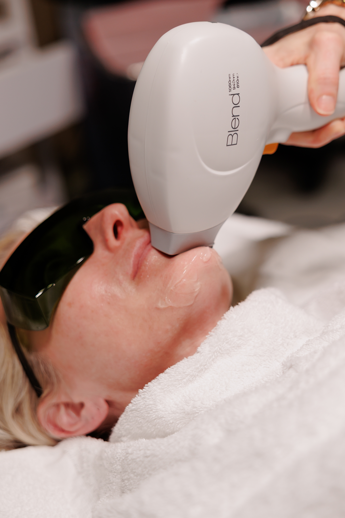 Laser hair removal treatment with Blend X technology at a medspa to reduce unwanted facial hair and achieve smoother skin.