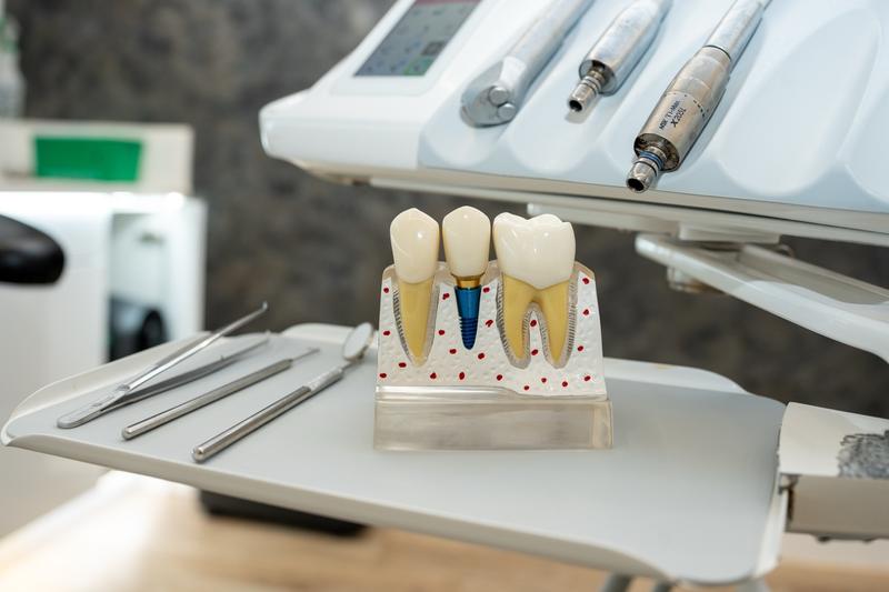 Dental model displaying a natural tooth, a tooth with a blue implant screw, and a tooth crown, placed on a tray with dental tools and equipment in a clinic.