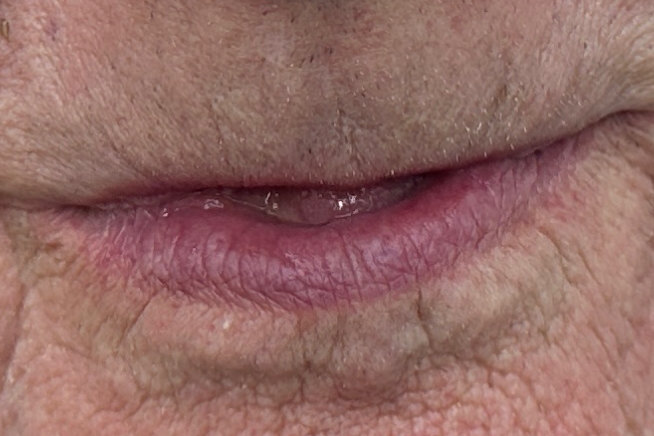 Patient teeth and gums before dental treatment