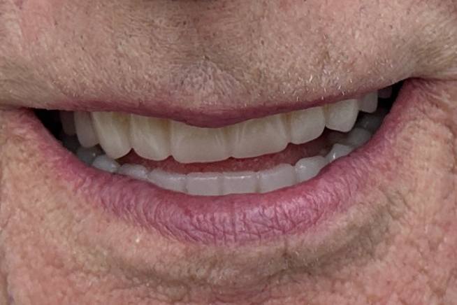 Patient teeth and gums after dental treatment