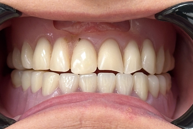 Patient teeth and gums before dental treatment