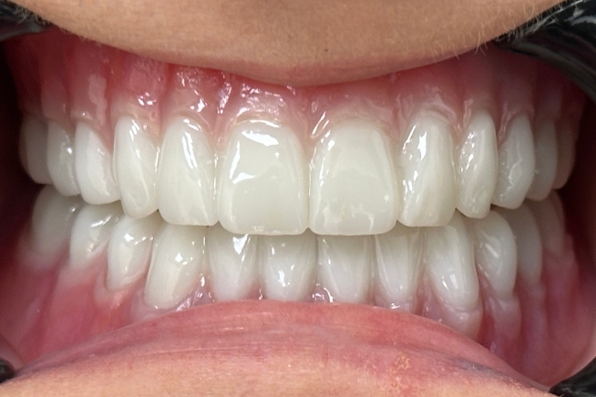 Patient teeth and gums after dental treatment