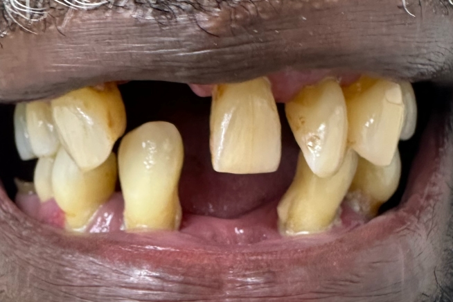 Patient teeth and gums before dental treatment
