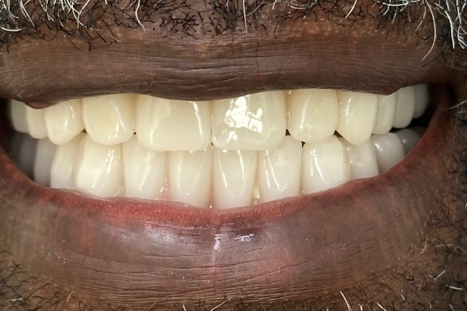 Patient teeth and gums after dental treatment