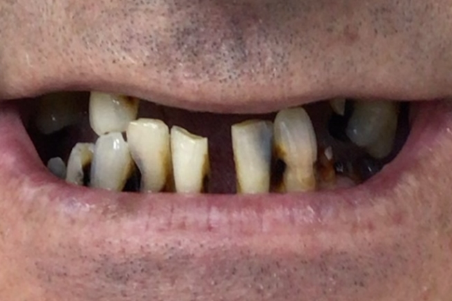 Patient teeth and gums before dental treatment