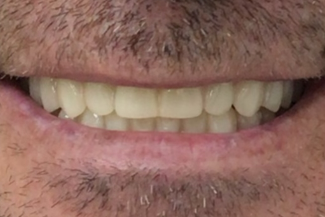 Patient teeth and gums after dental treatment