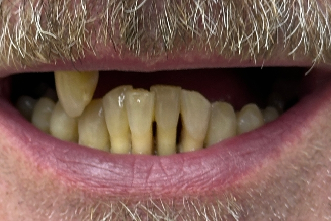 Patient teeth and gums before dental treatment