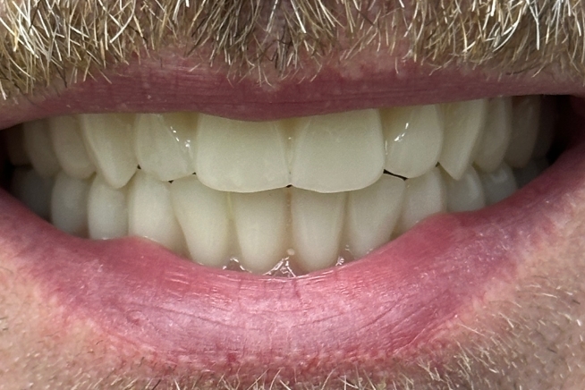 Patient teeth and gums after dental treatment
