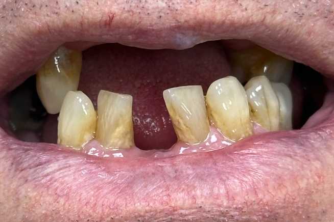 Patient teeth and gums before dental treatment