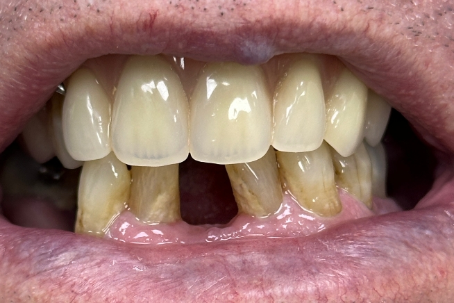 Patient teeth and gums after dental treatment