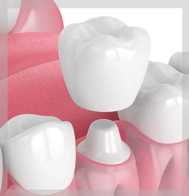An image showing Crowns