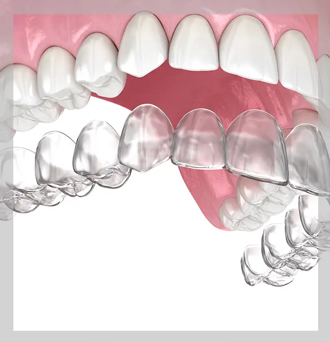 An image showing Invisalign