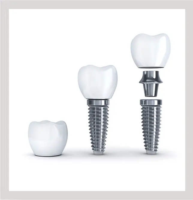 An image showing Dental Implants