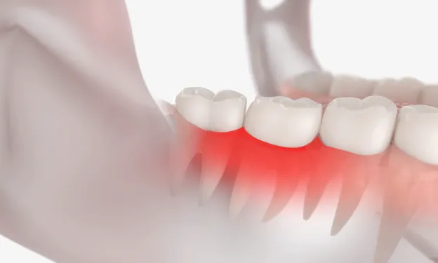 A close up of a tooth with red gums.