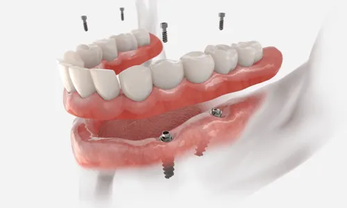A diagram of a tooth with screws in it.
