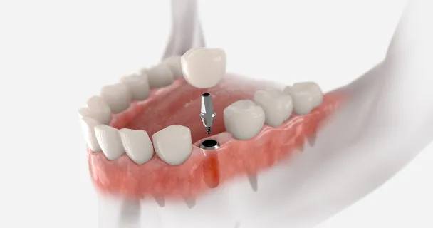 Single Implants (Crowns)