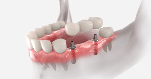 Bridge Implants