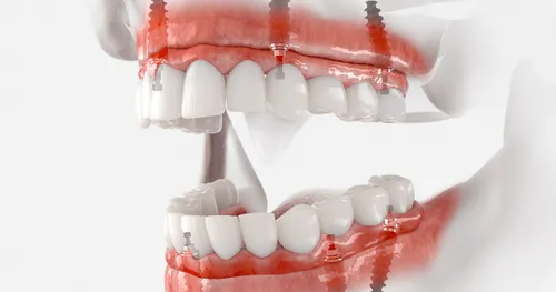 Implant-Supported Dentures