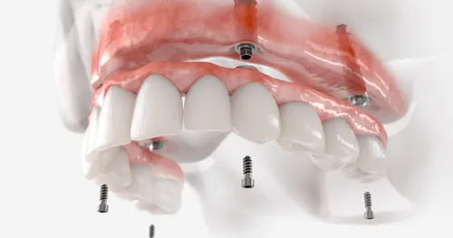 Full Arch / Full Mouth Restoration