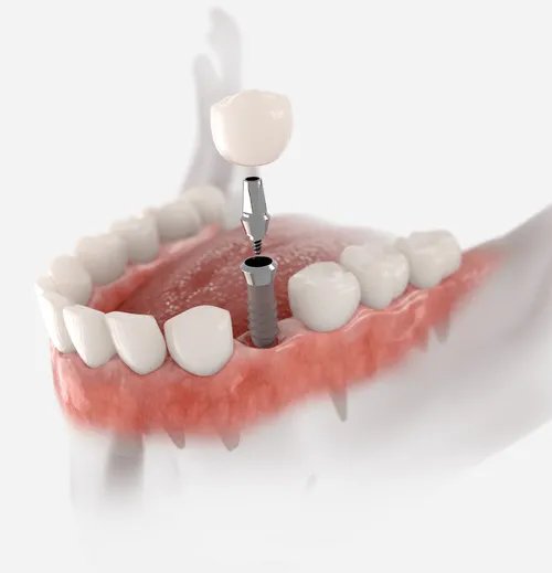 A model of a tooth with a dental tool in it.