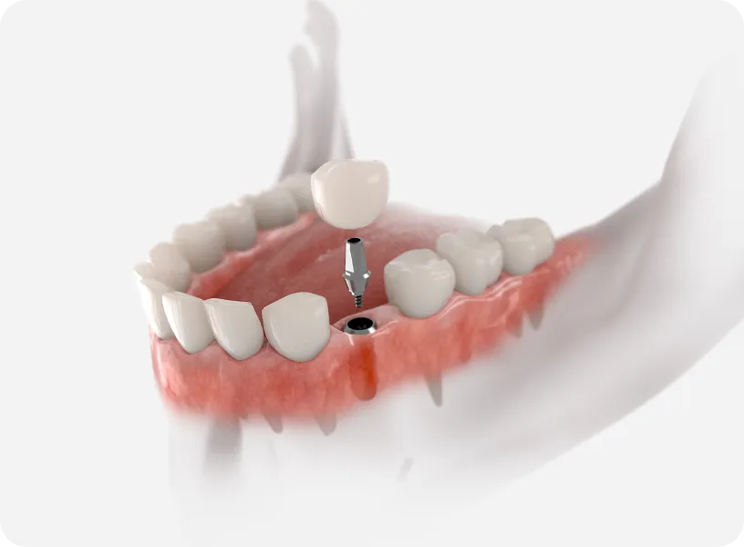 A model of a tooth with a hole in the middle.