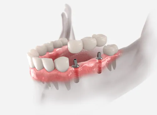 A dental model of a tooth with implants.