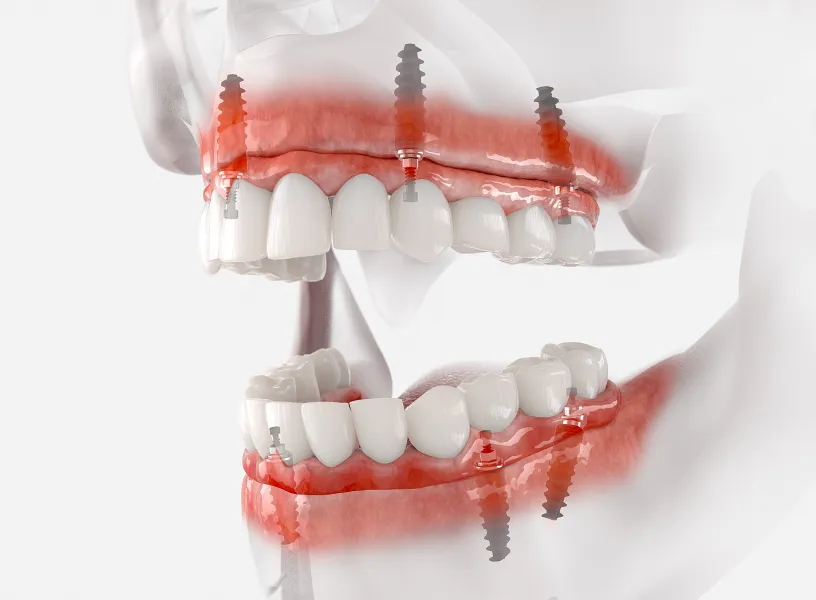 A model of a teeth with gums and gum bridges.