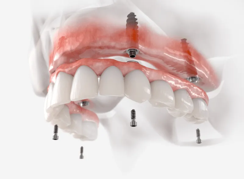 A model of a human mouth with implants attached to it.