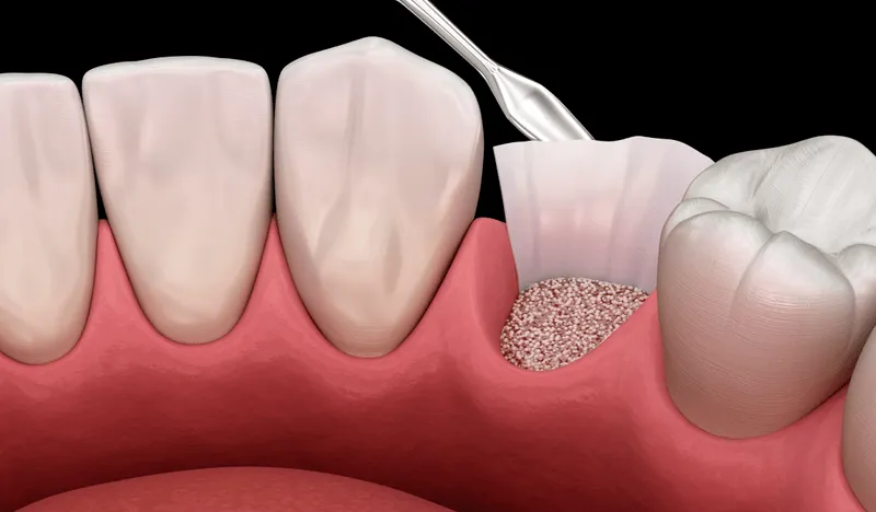 Guided Tissue…neration