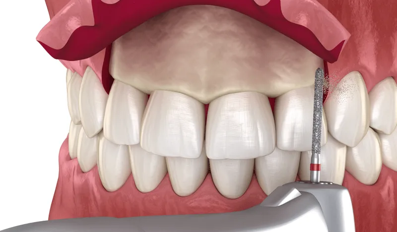 Crown Lengthening