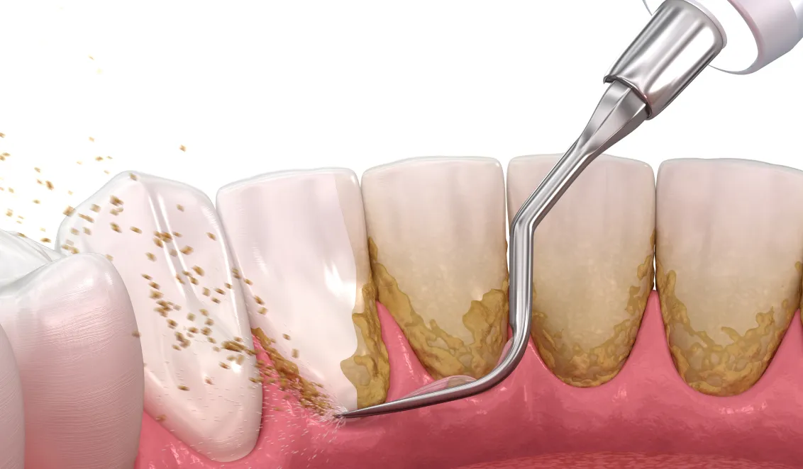 A dental procedure being performed on a tooth.