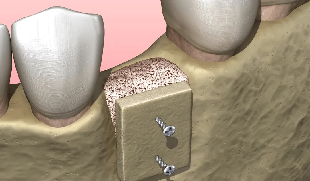 Bone Grafting