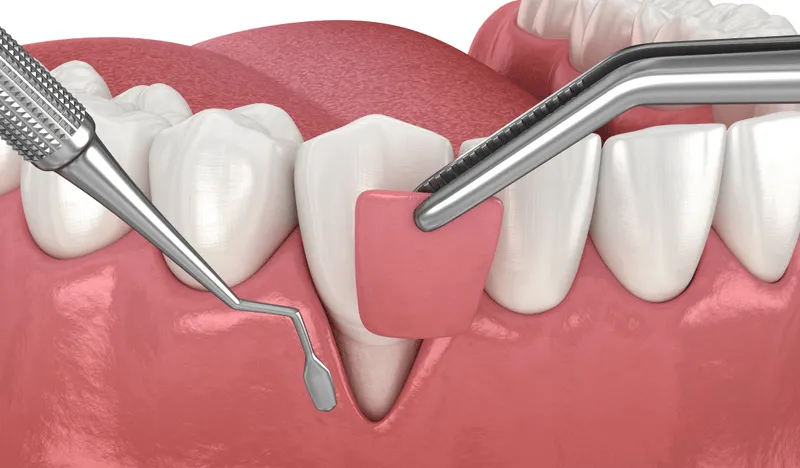 Soft Tissue Grafting