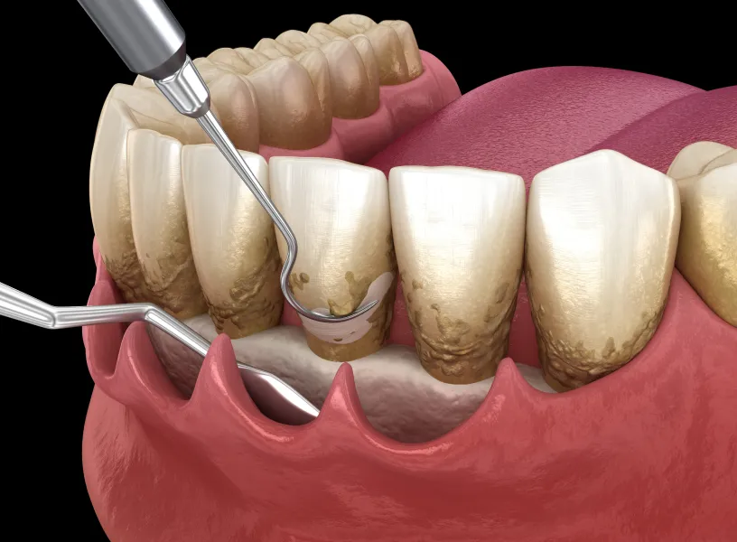 A dental procedure being performed on a tooth.