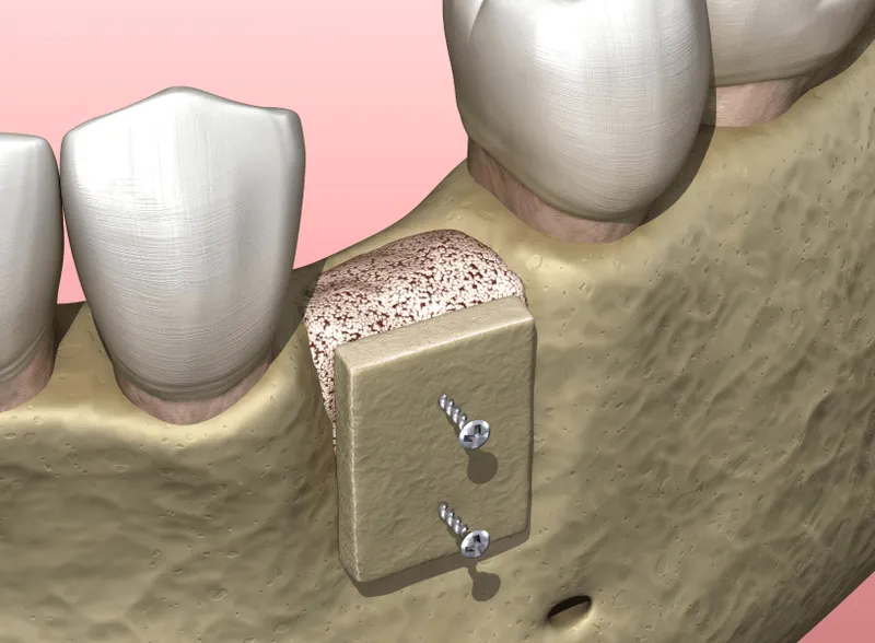 A computer generated image of a dental model.