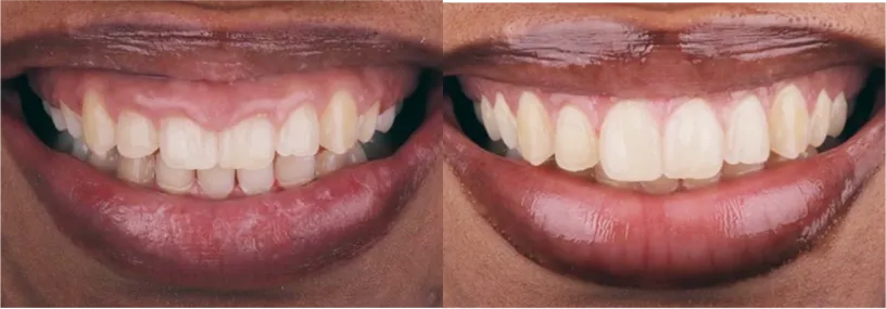 A close up of a person's mouth with teeth missing.