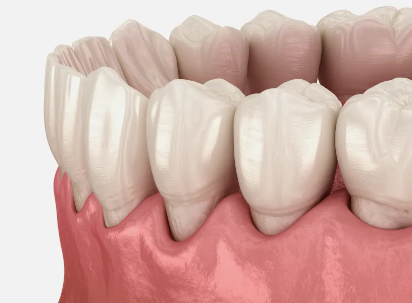 A close up of a tooth with a missing tooth.
