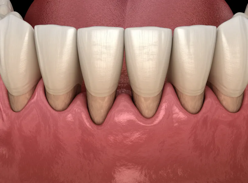 A close up of a tooth with a missing tooth.