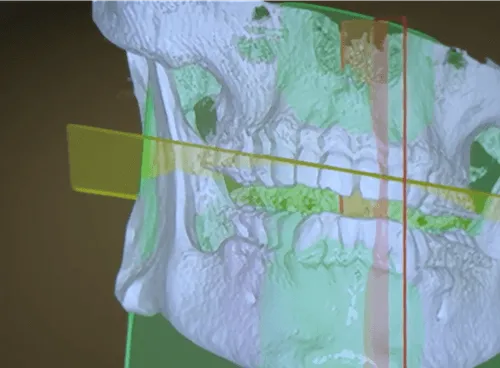 A picture of a dental model of the mouth.