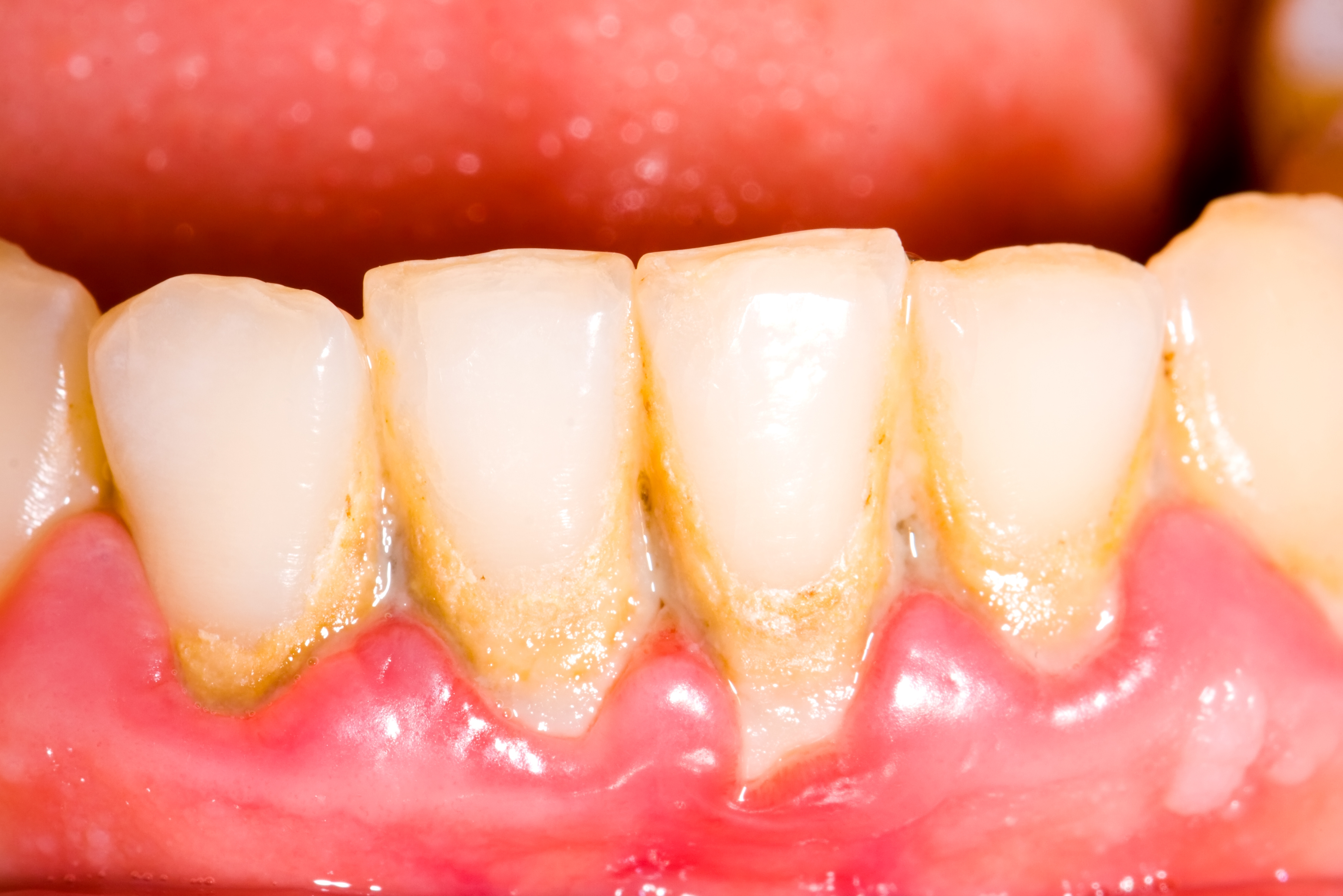 What Is Tartar?