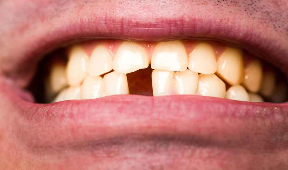 From Tooth Loss to Restoration: Exploring Dental Implant Solutions