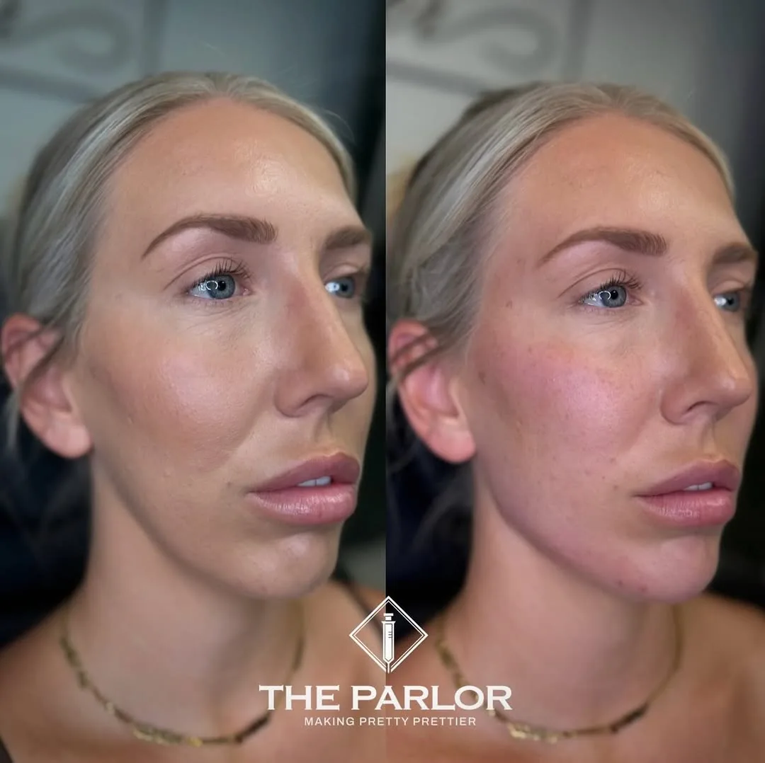 Facial balancing before and after at The Parlor Medspa, Scottsdale AZ – natural contour and harmony