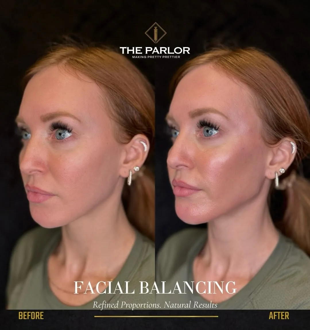 Facial balancing before and after by Jake Collins, RN at The Parlor Medspa, Scottsdale AZ – refined proportions