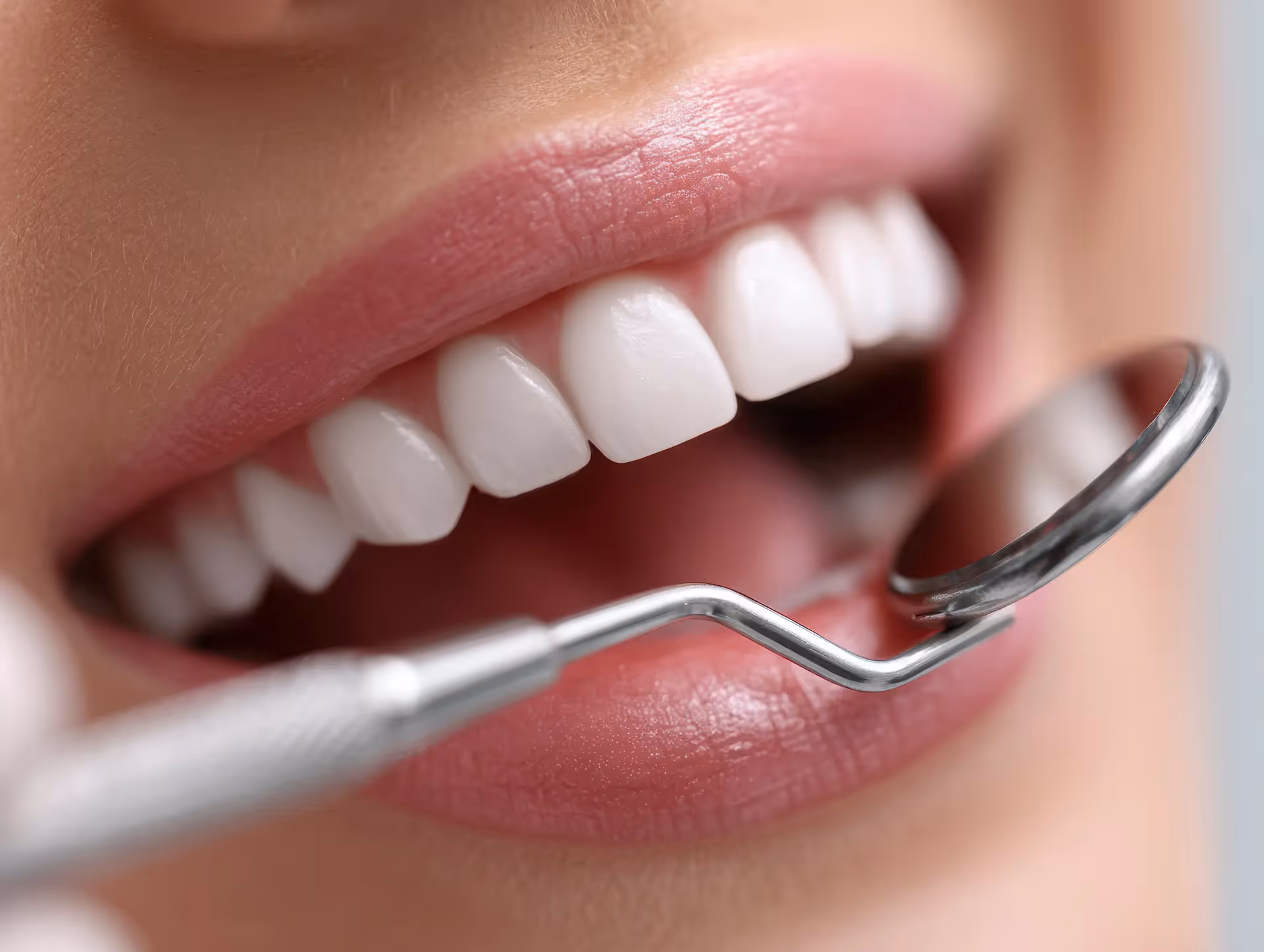 Fluoride Treatment