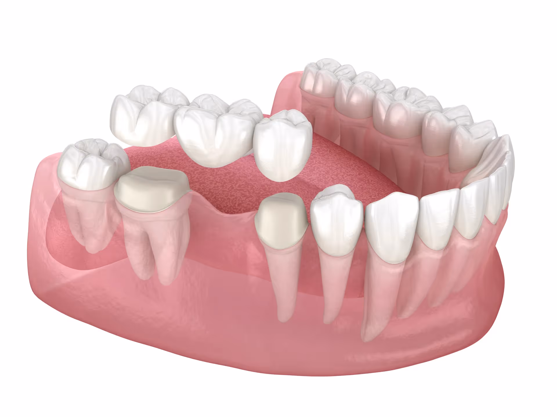 Dental Bridges