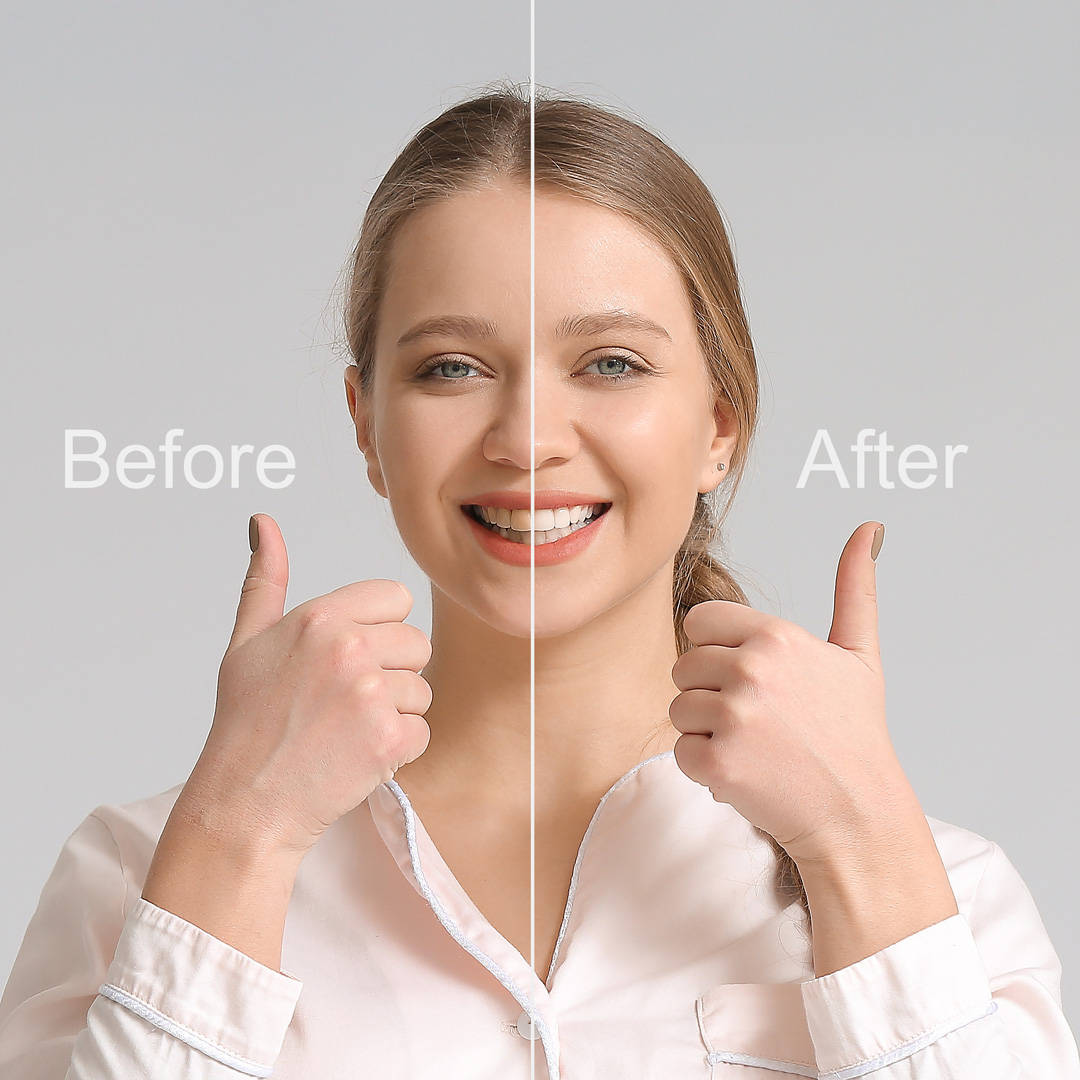 Smile Makeovers