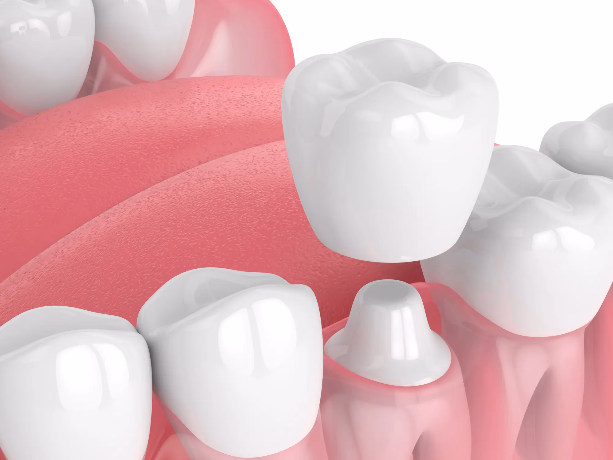 dental crown diagram