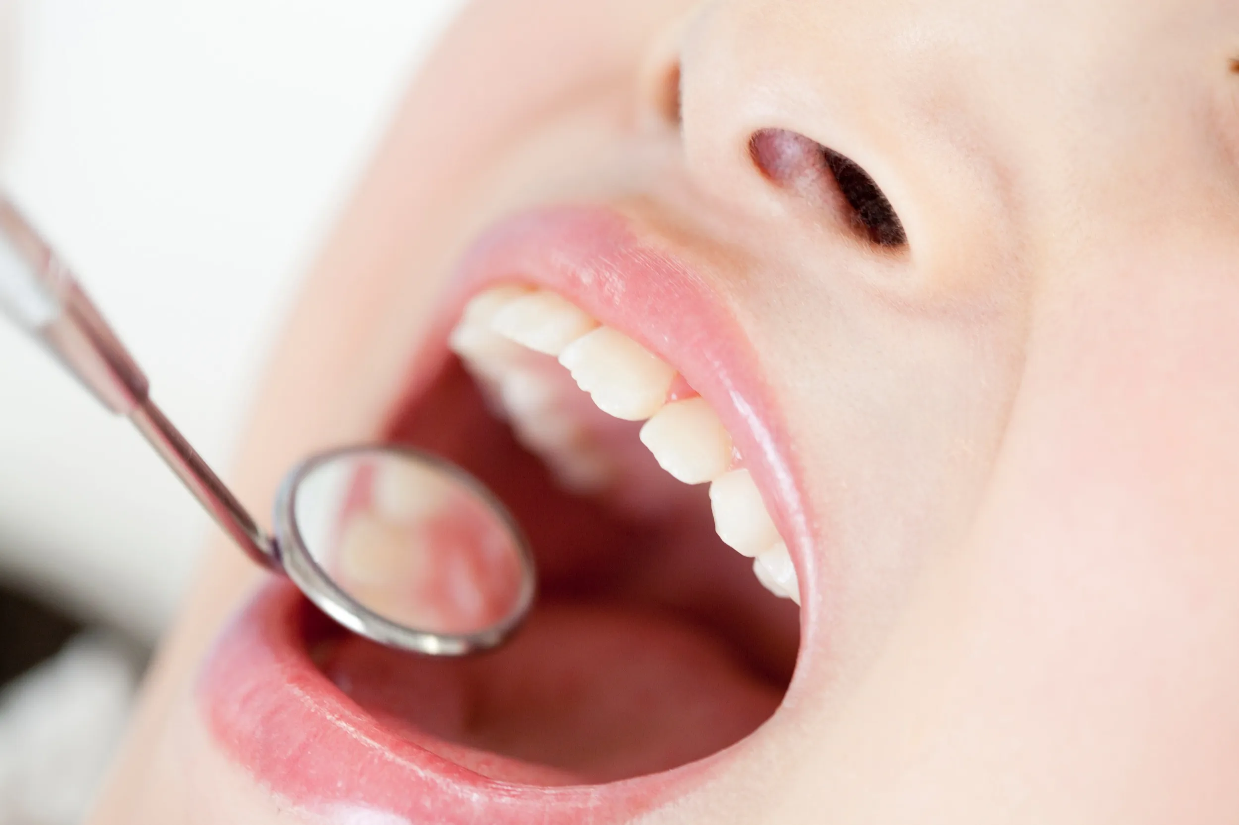 Dental examination with mouth open and dental mirror reflecting teeth