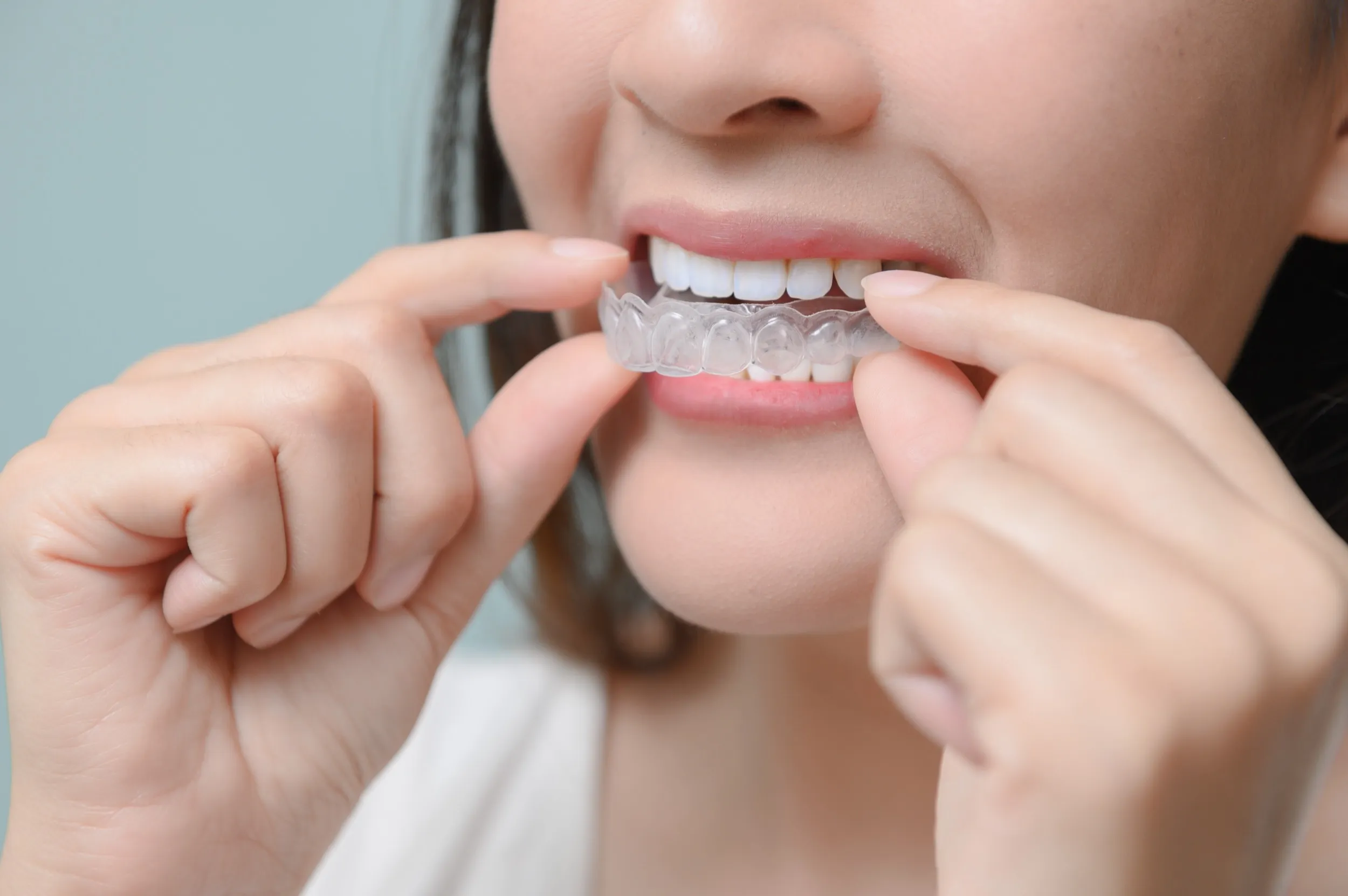 Person placing clear dental aligner on teeth for orthodontic treatment